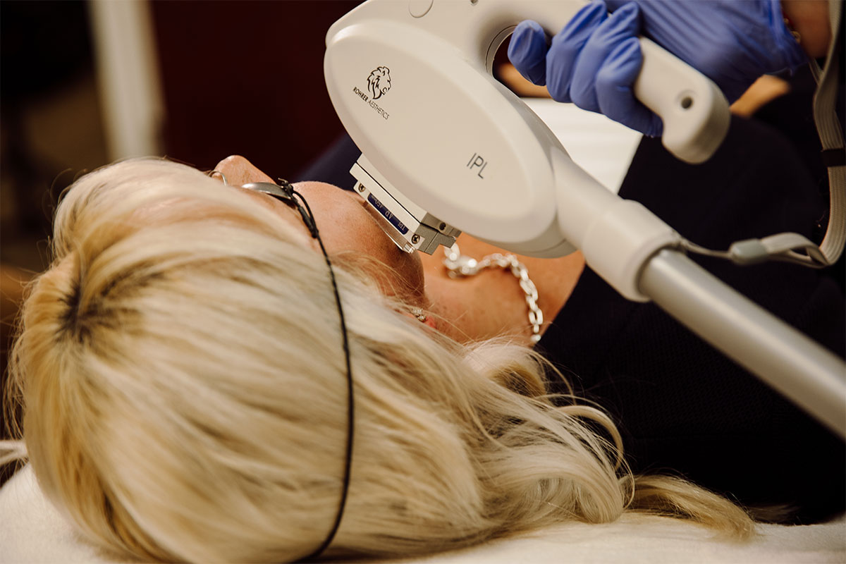 woman during IPL laser in Golden