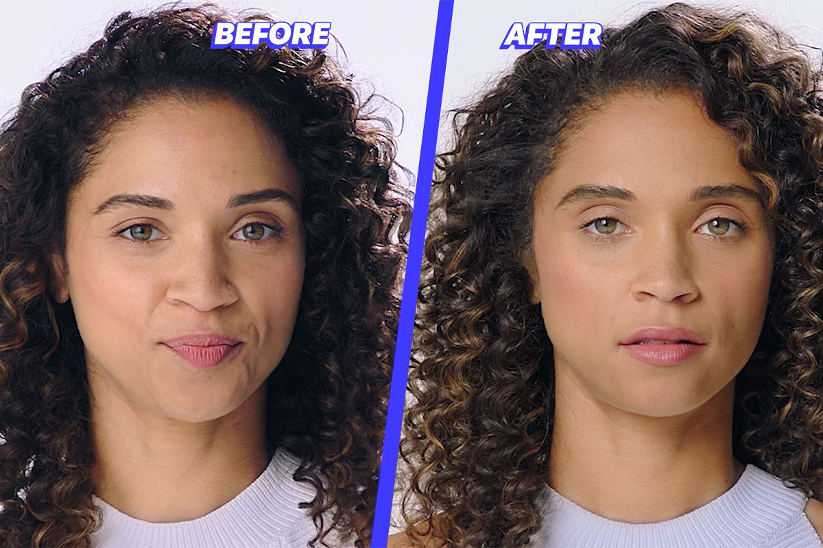 woman before and after Juvéderm injections in Golden