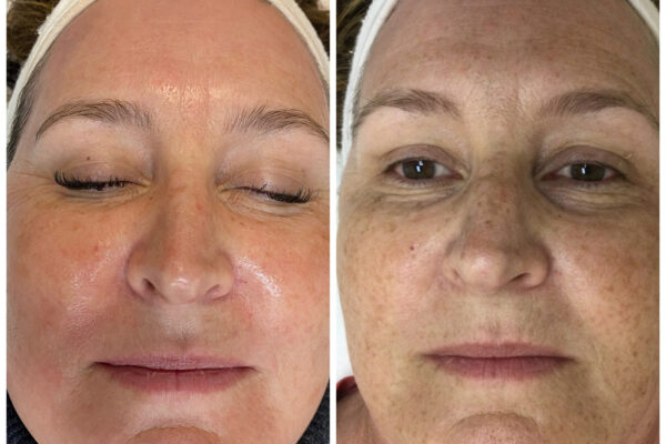 ipl_photofacial_2 ipl_photofacial_2