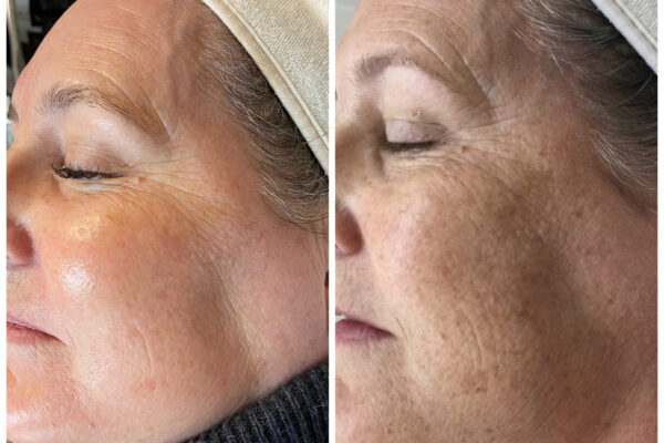 ipl_photofacial_3 ipl_photofacial_3