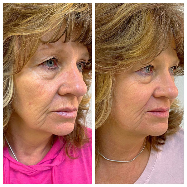 skin-tightening-2 Before and after skin tightening treatment in Golden, CO showing reduced wrinkles, smoother skin texture, and improved skin firmness in the lower face and jawline.