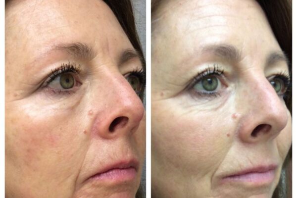 dermal-fillers-subpage-1 dermal-fillers-subpage-1