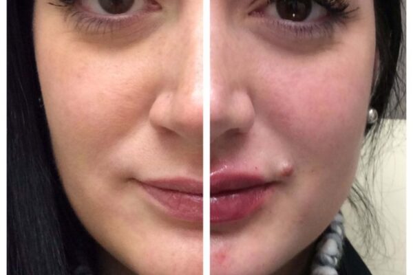 dermal-fillers-2a dermal-fillers-2a