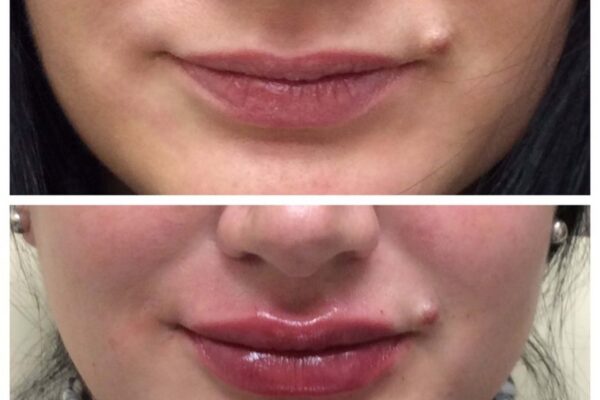 dermal-fillers-2b dermal-fillers-2b