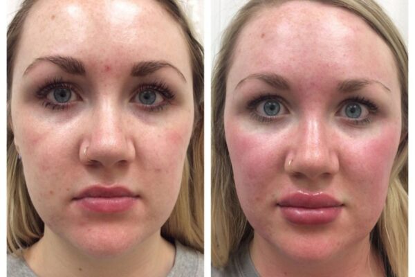 dermal-fillers-3a dermal-fillers-3a