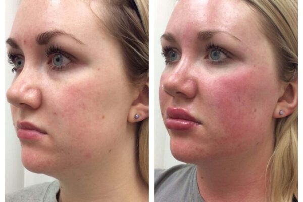 dermal-fillers-3b dermal-fillers-3b