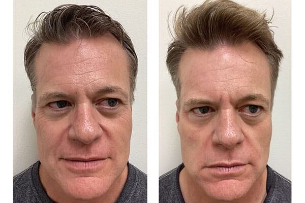 laser-skin-resurfacing-1b laser-skin-resurfacing-1b