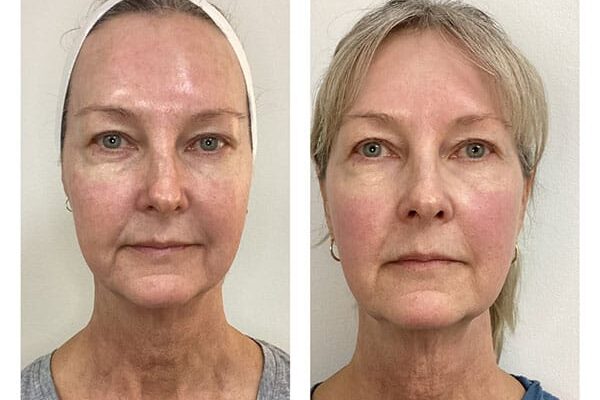 laser-skin-resurfacing-2b laser-skin-resurfacing-2b