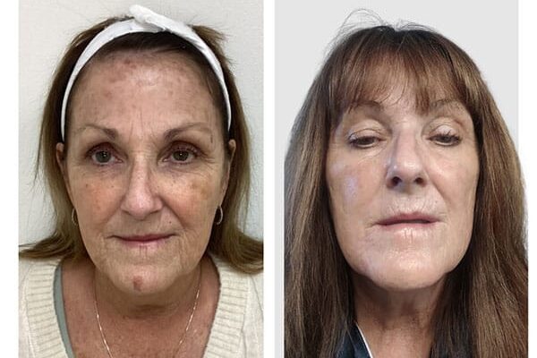 laser-skin-resurfacing-3 laser-skin-resurfacing-3