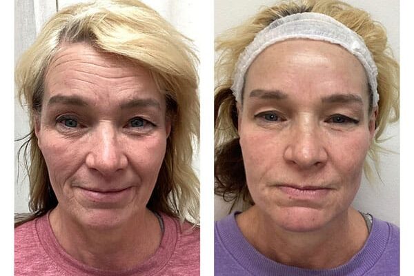 laser-skin-resurfacing-4 laser-skin-resurfacing-4
