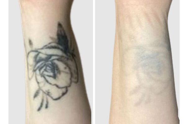 tattoo-removal-1 tattoo-removal-1